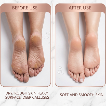 Foot Scrubber for Dead Skin, Callus Remover with Roller